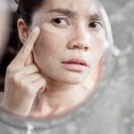 Vous avez des taches pigmentaires ? Voici comment les atténuer