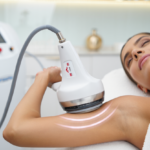 Pourquoi la radiofréquence est plébiscitée pour les cuisses et bras ?